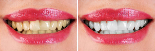Smile makeover
